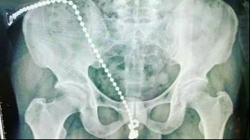 Fotografia de exame mostrando a corrente dentro do corpo do homem - Divulgação/ Universidade Médica de Taipé